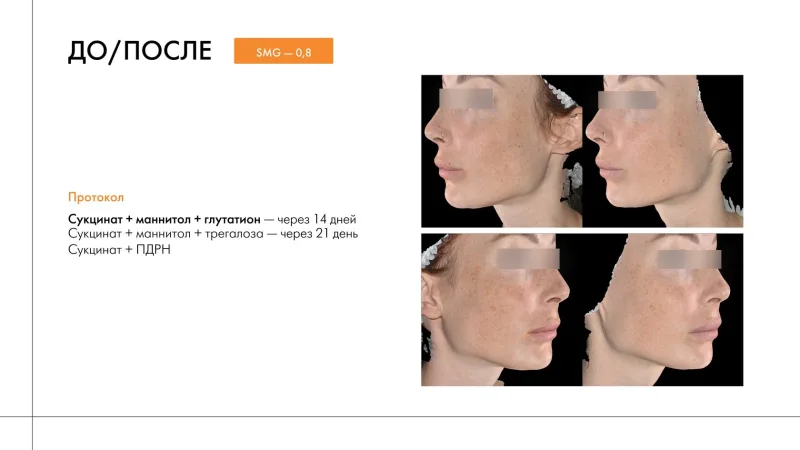 before/after