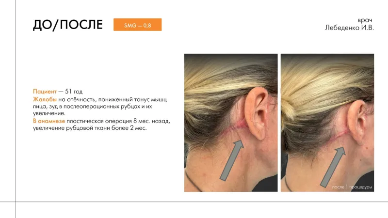 before/after