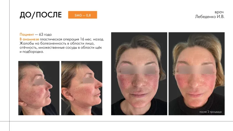 before/after