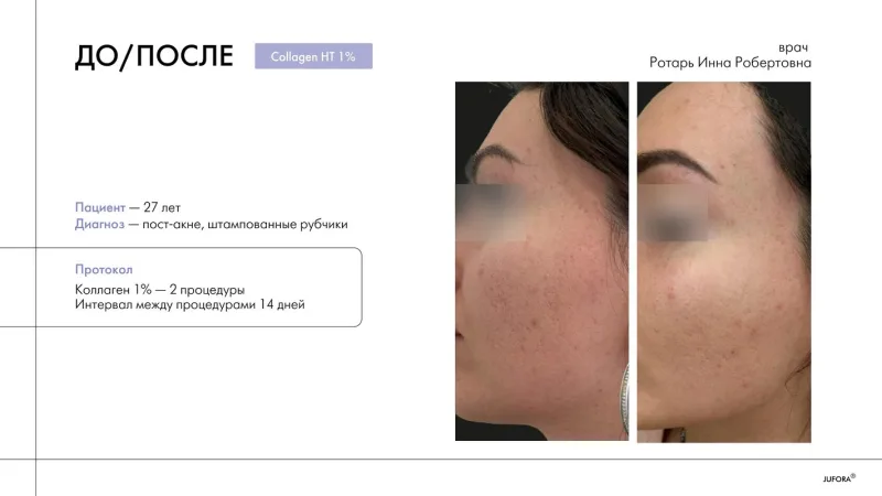 before-after protokol collagen-HT